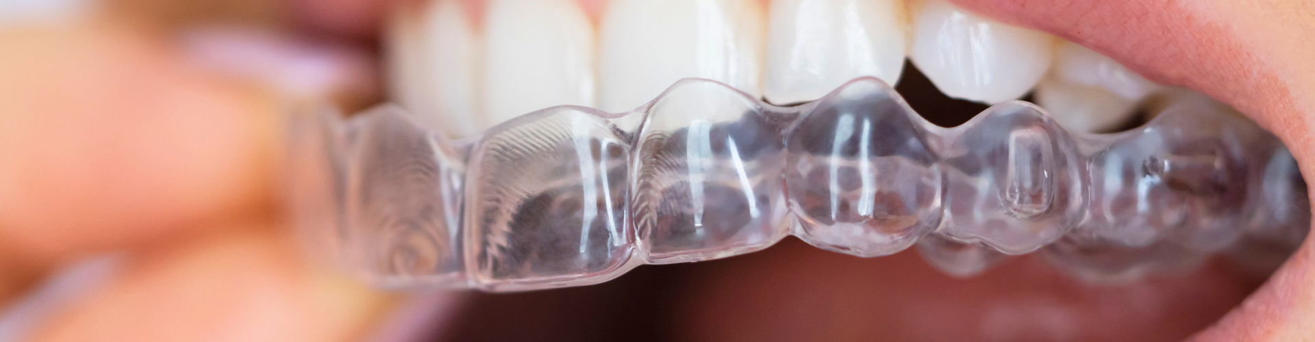 Close up of aligner being placed on upper teeth.